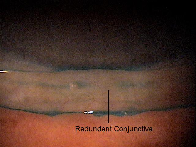 H11.821823 Conjunctivochalasis DecisionMaker PLUS