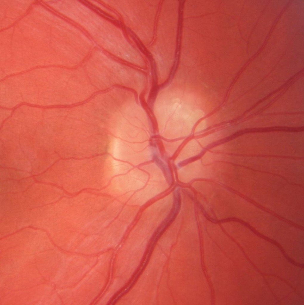 H47.321323 Optic Nerve Drusen DecisionMaker PLUS