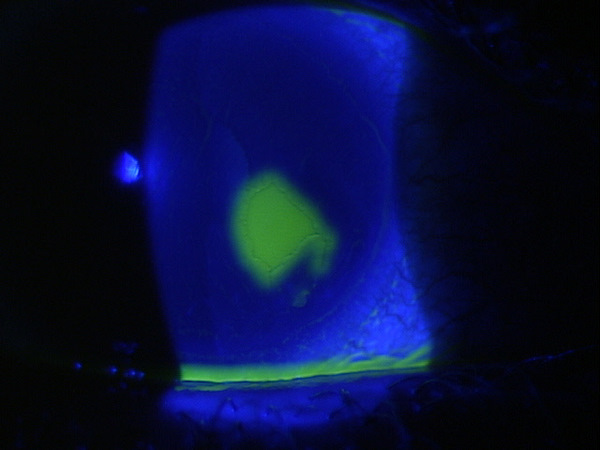 S05.01XA02XS Superficial Injury of Cornea DecisionMaker PLUS