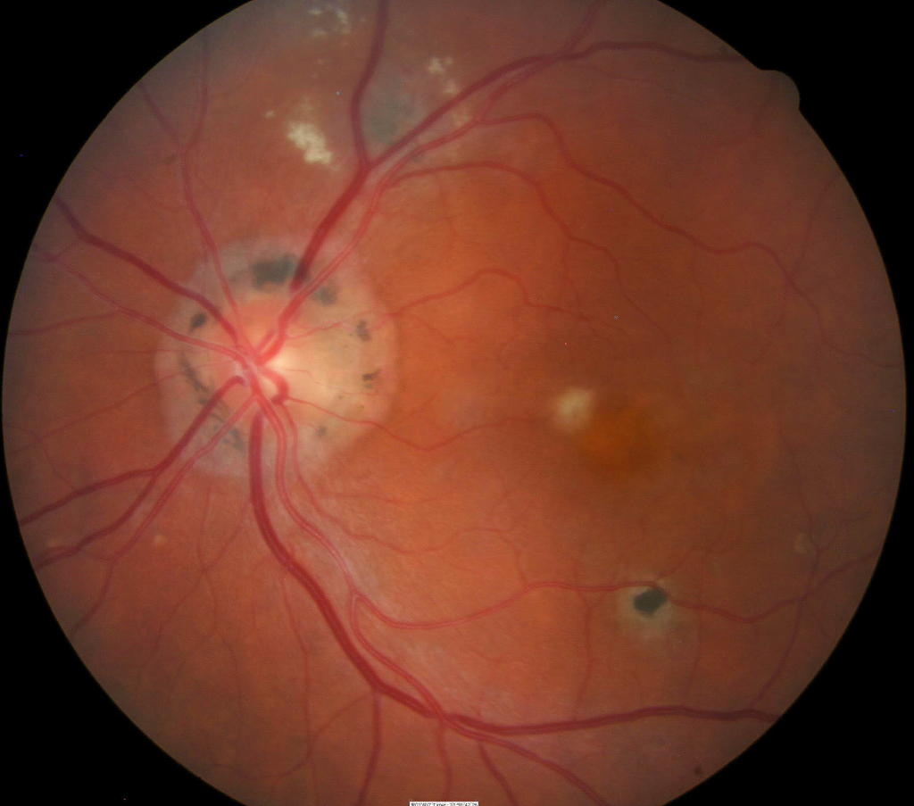 H33.011013 Retinal Detachment with Retinal Defect DecisionMaker PLUS