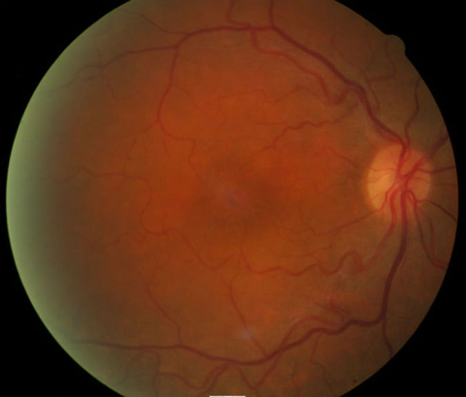 Icd 10 Code For Neovascular Age Related Macular Degeneration