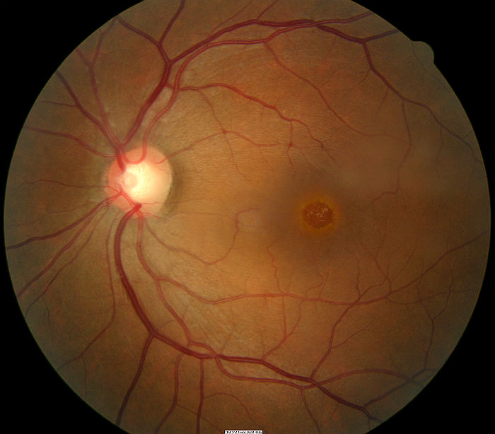 Vitreomacular Traction Syndrome DecisionMaker PLUS
