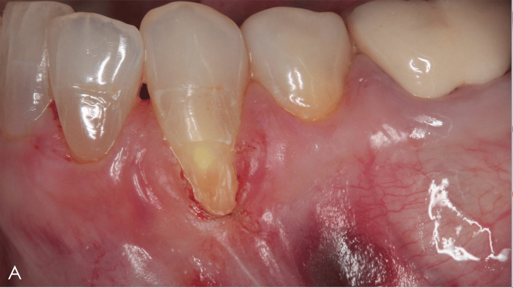 Clinical Considerations for Root Coverage Procedures Decisions in