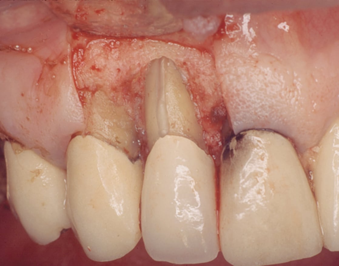 Original Research Vertical Root Fracture Repair With a ResinIonomer
