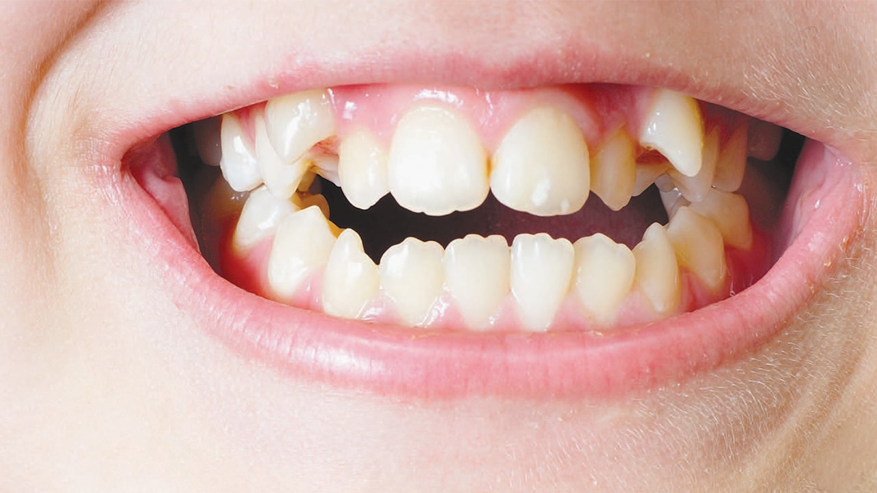 Passive Space Management in Children—Decisions in Dentistry