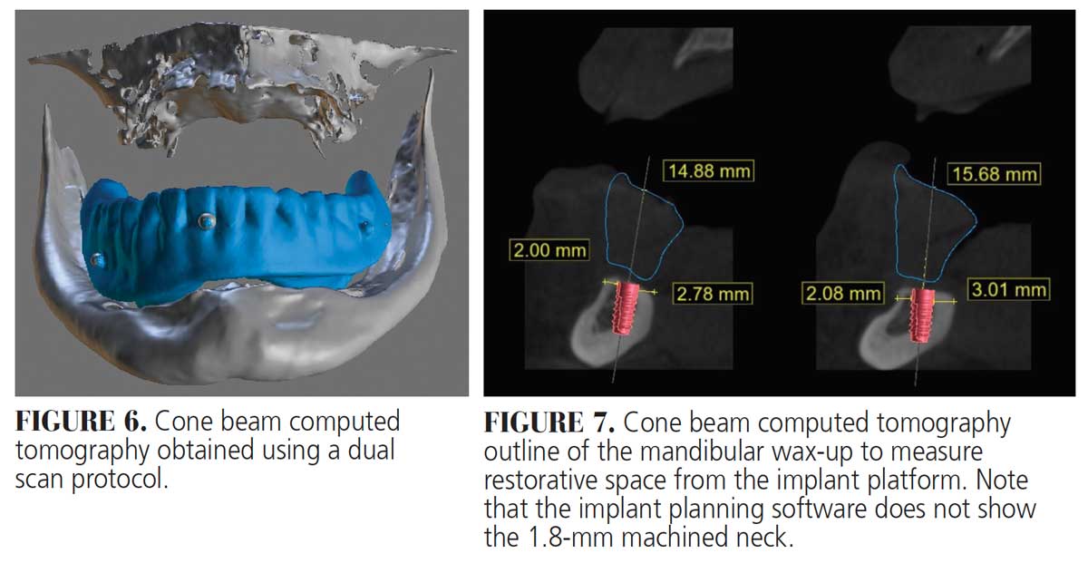 Clinical Utility of Short Dental Implants Decisions in Dentistry