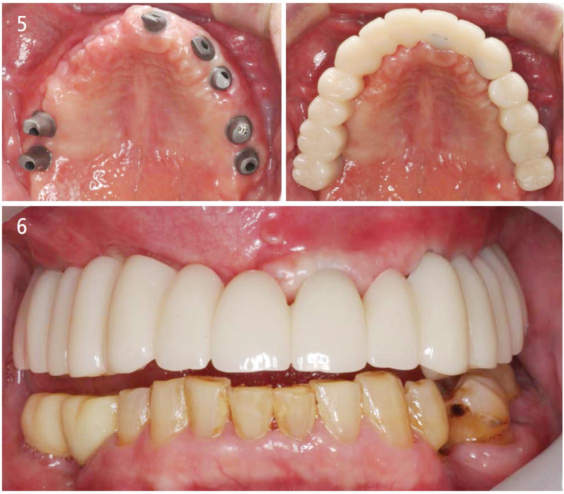 Intraoral Scanning in the Creation and Application of Duplicate