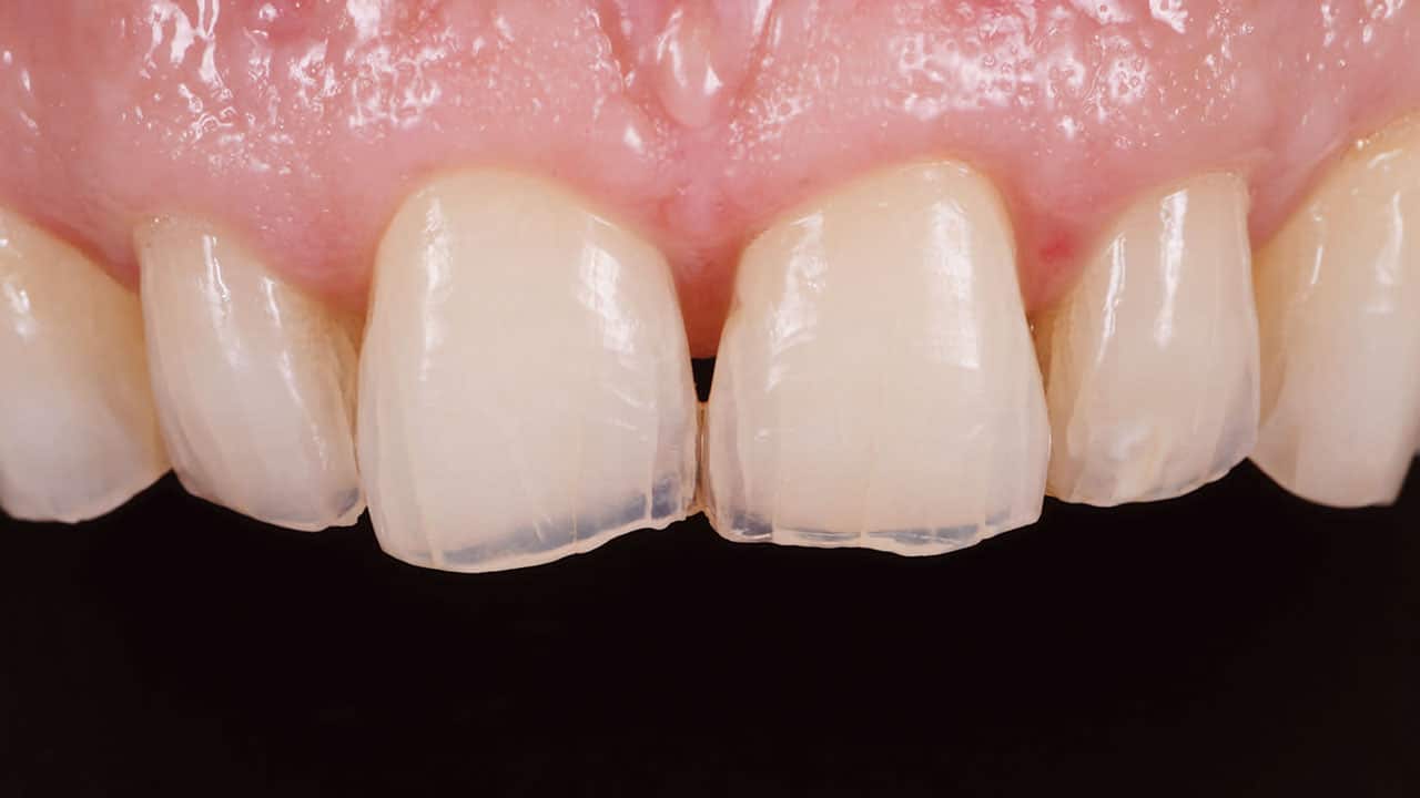 Achieve Positive in Full Mouth Esthetic and Functional