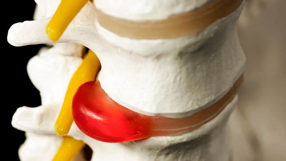 Relief for Herniated Disc with Spinal in Dublin, Ireland