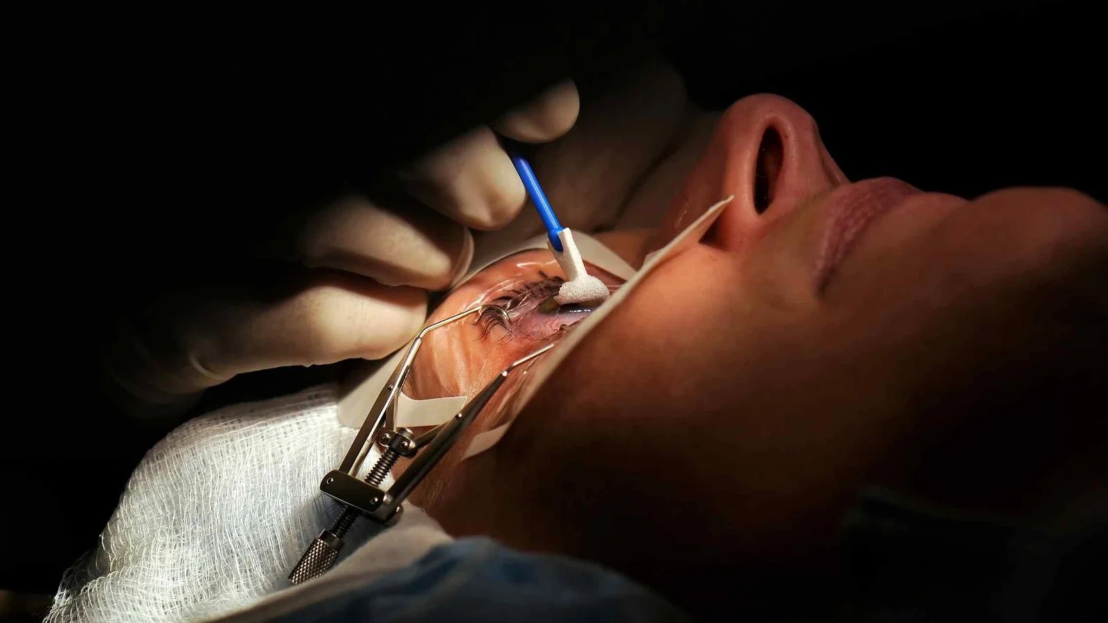 LASIK Manfaat, Risiko, Prosedur dan Biaya Operasi Klinik Mata.
