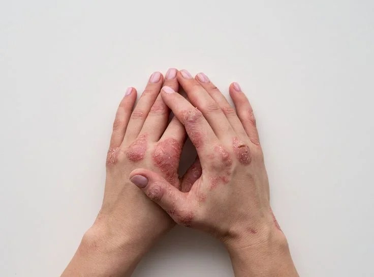 Stressed Skin? Unmasking the EczemaStress Connection