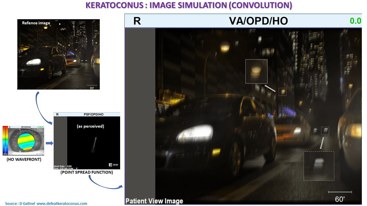 Visual disturbances in keratoconus | Defeat Keratoconus