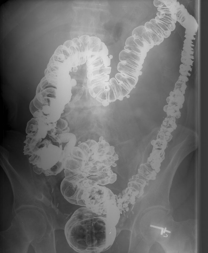 Fecal Incontinence Defecatory Disorder Center