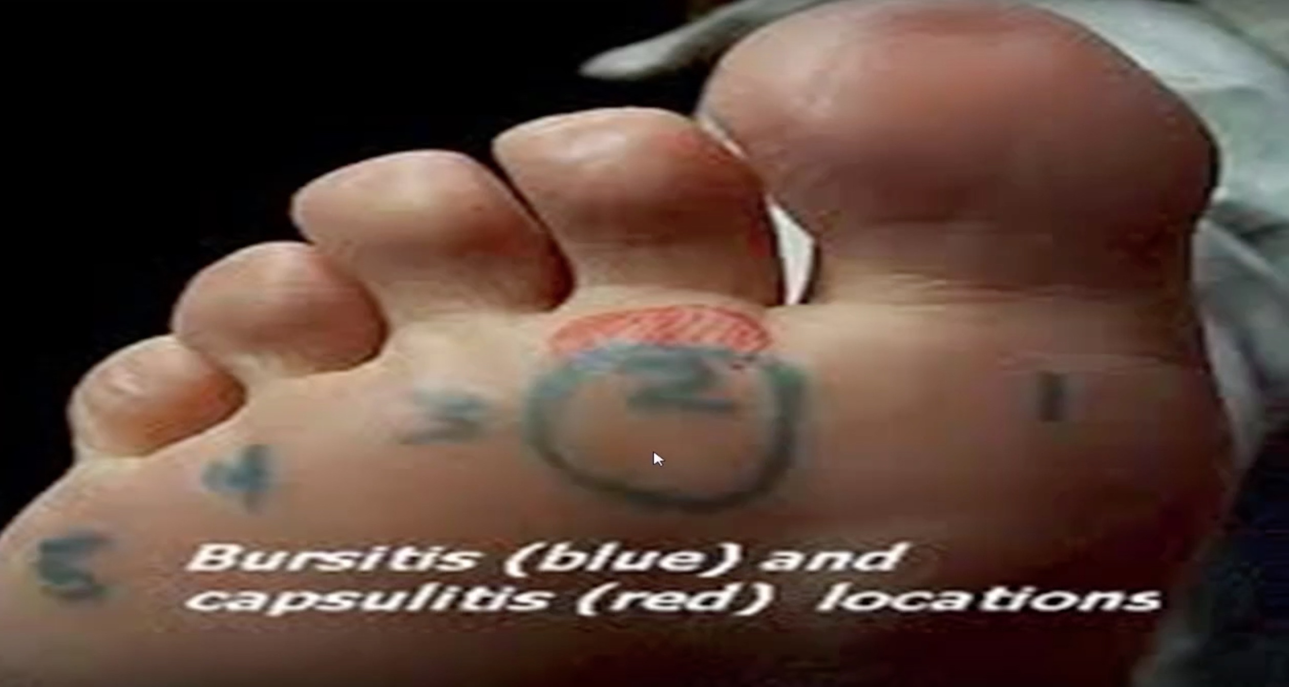 Capsulitis of the Second Toe & the Most Effective Treatments