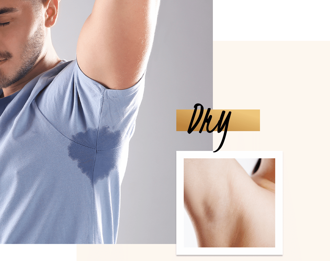 Sweating and hyperhidrosis Treatment with MiraDry at Define Medical
