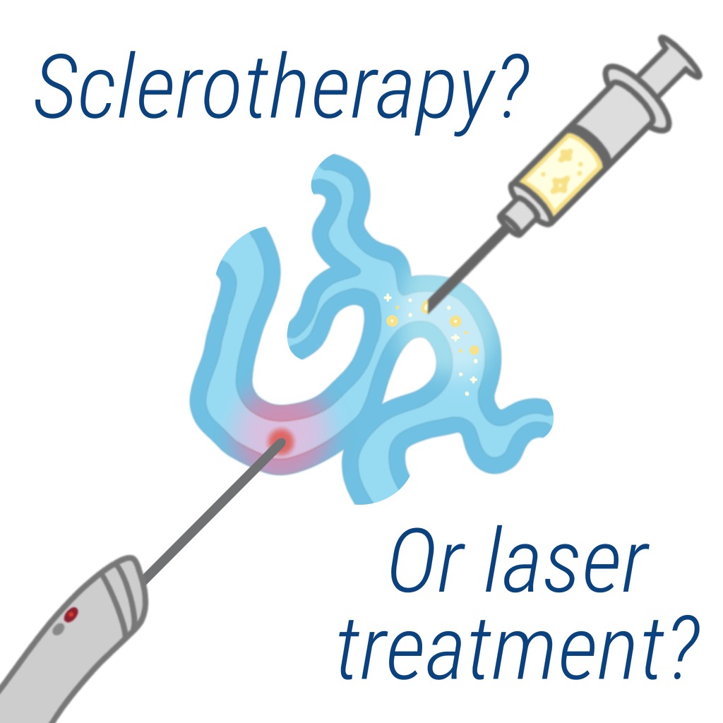 Sclerotherapy or Laser Which is Better for Getting Rid of Spider Veins