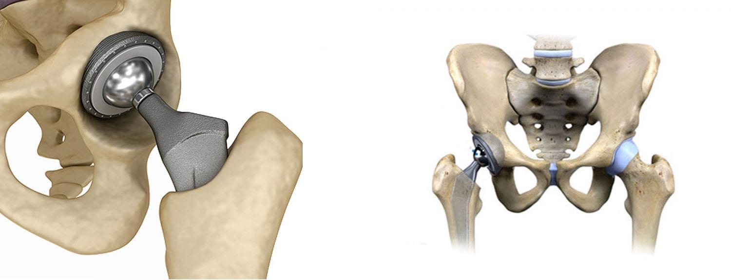 totalhipreplacement Cedar Orthopaedic Surgery Specialty Clinic