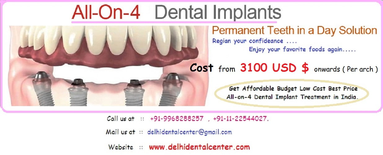 Cost of full mouth Allon4 dental implant in India Delhi Dental Center