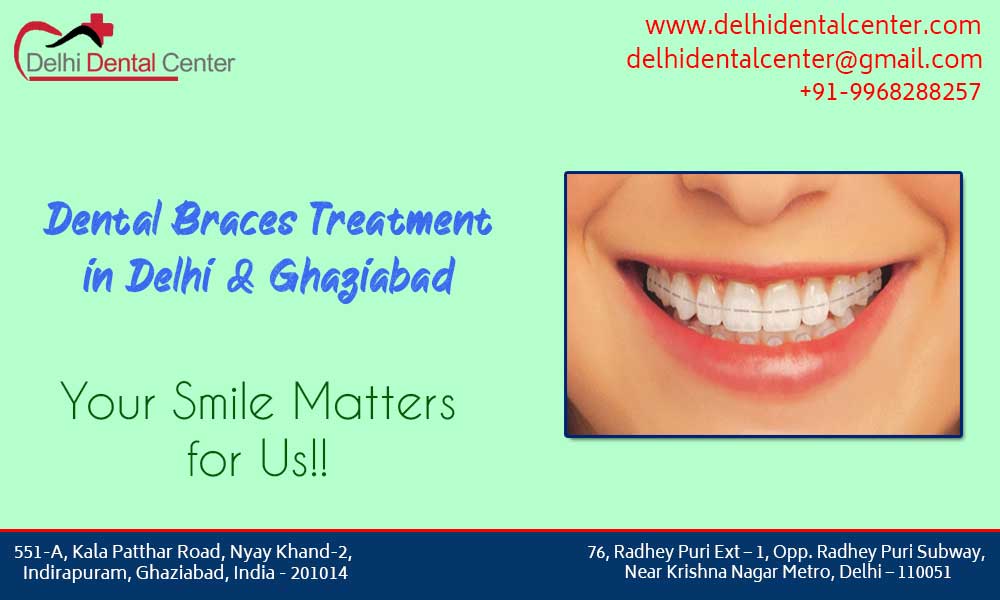 Dental Braces in Noida Delhi Dental Center