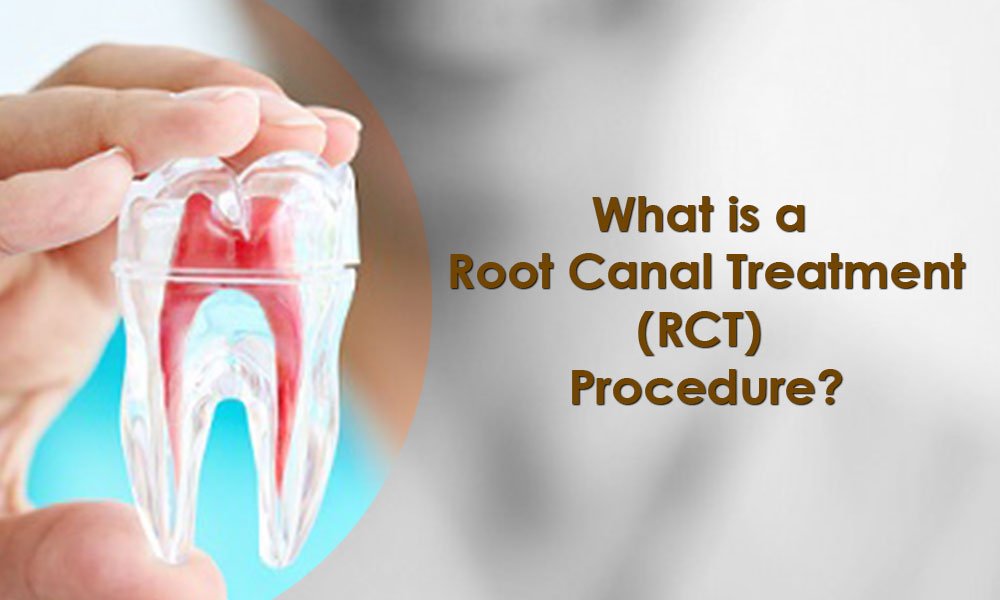 RCT Treatment in East Delhi Delhi Dental Center