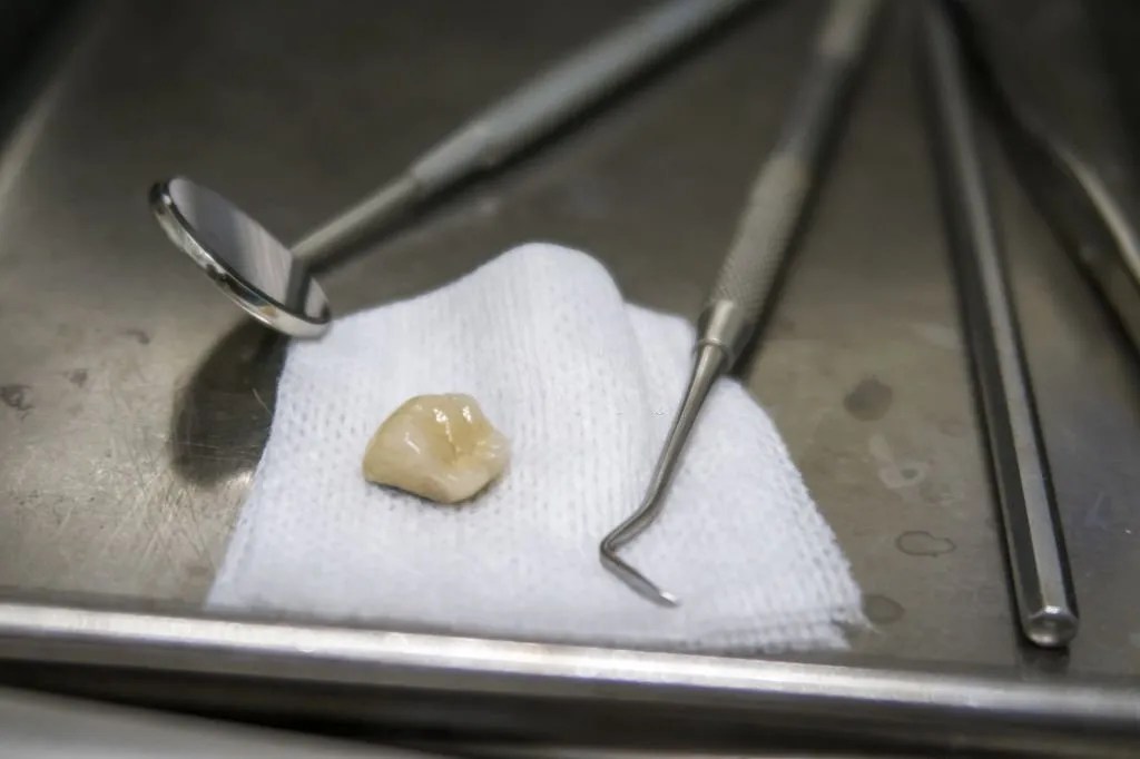 How Long To Leave Gauze In After Tooth Extraction