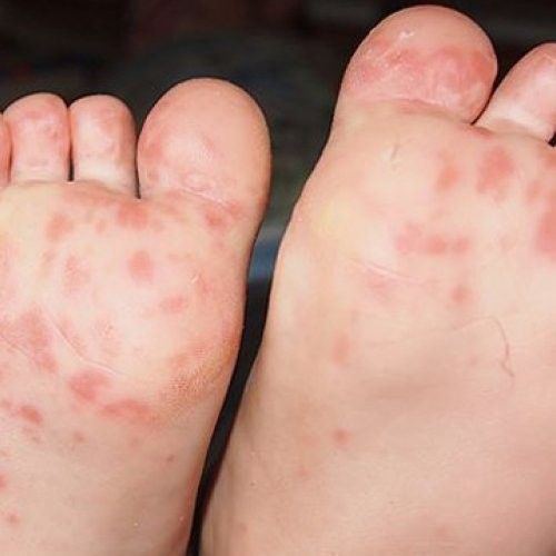 maladies les maladies contagieuses