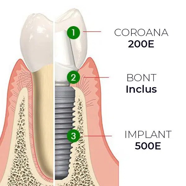 Implant Dentar Pret 6 factori care decid cat costa un implant dentar