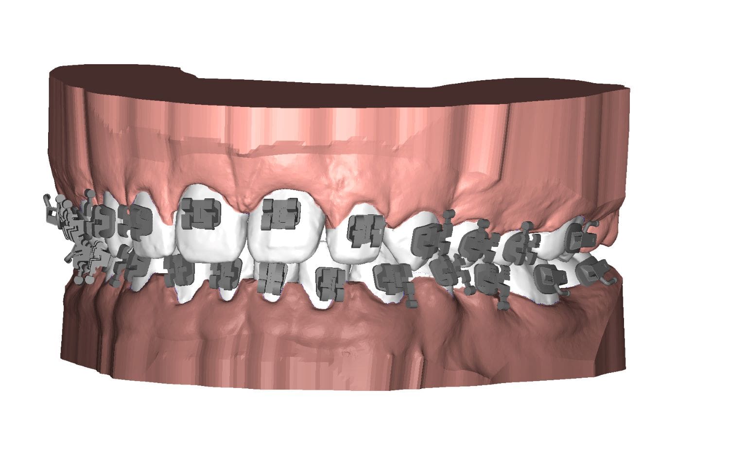 UBrackets Customised brackets and indirect bonding Deltaface