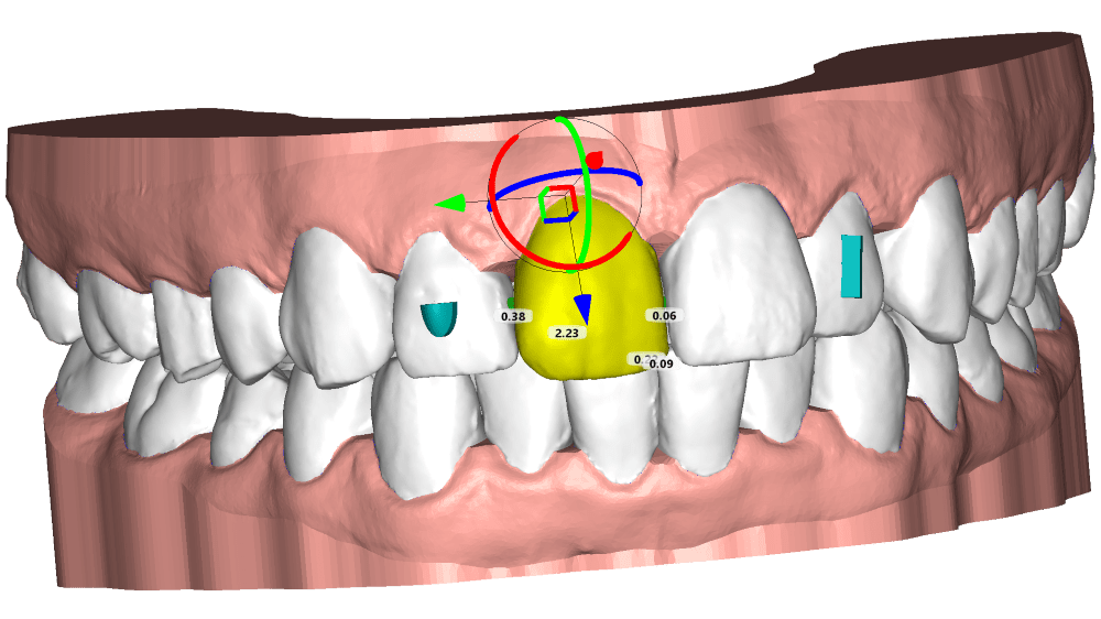 3D orthodontics software solutions Deltaface