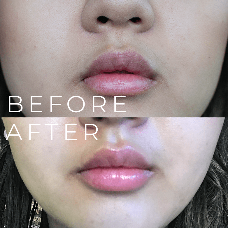 Lip Fillers 101: How long they’ll last, what you can expect to pay,.