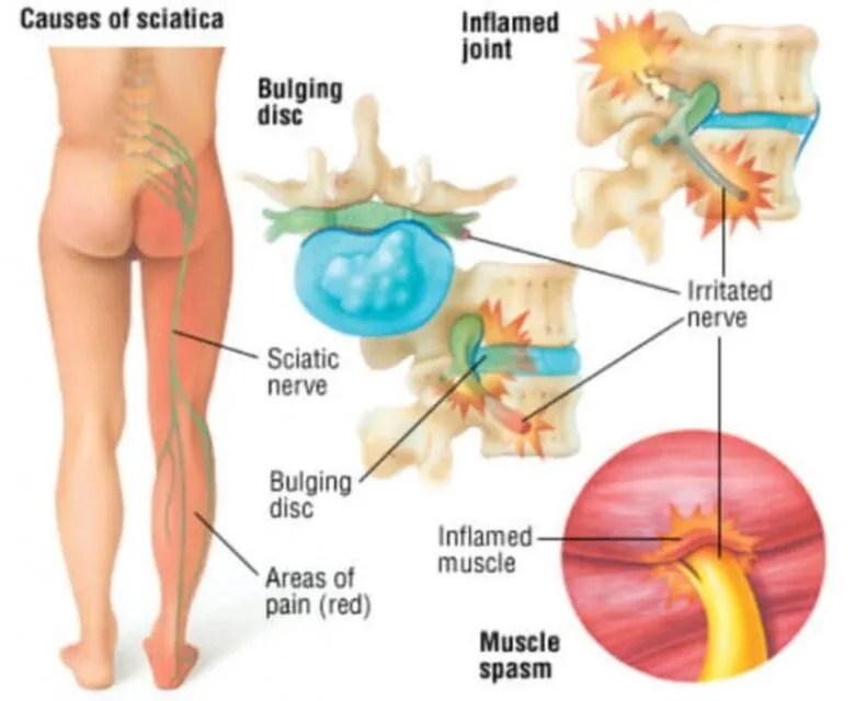 How To Stop Pain In Sciatic Nerve?