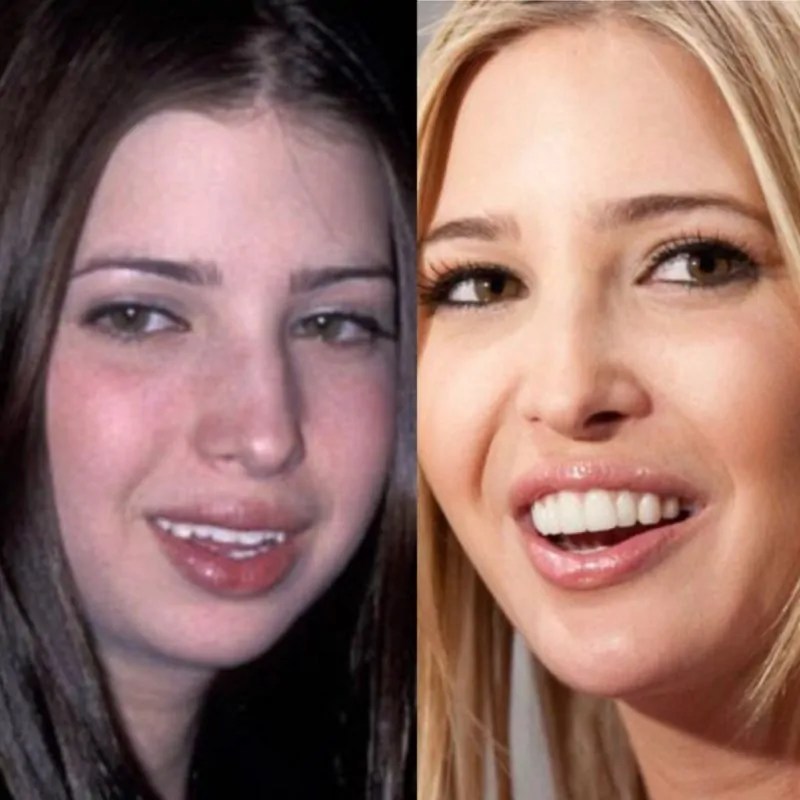 Before & After All Ivanka Trump’s Plastic Surgeries and Cosmetic Procedures