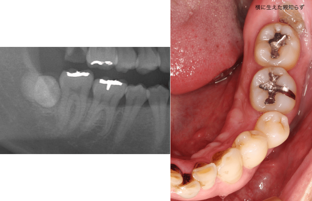 親知らずって虫歯じゃなくても抜いた方がいいの？ dencle