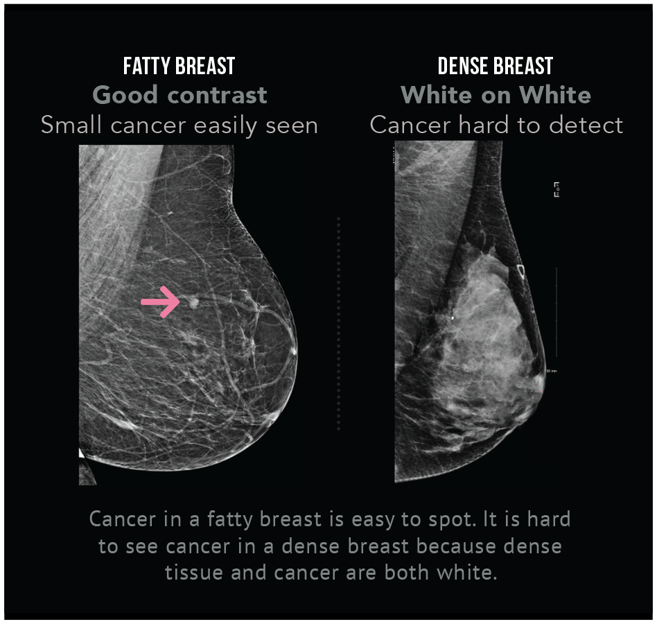 Get Informed Dense Breasts Canada Find out your breast density.