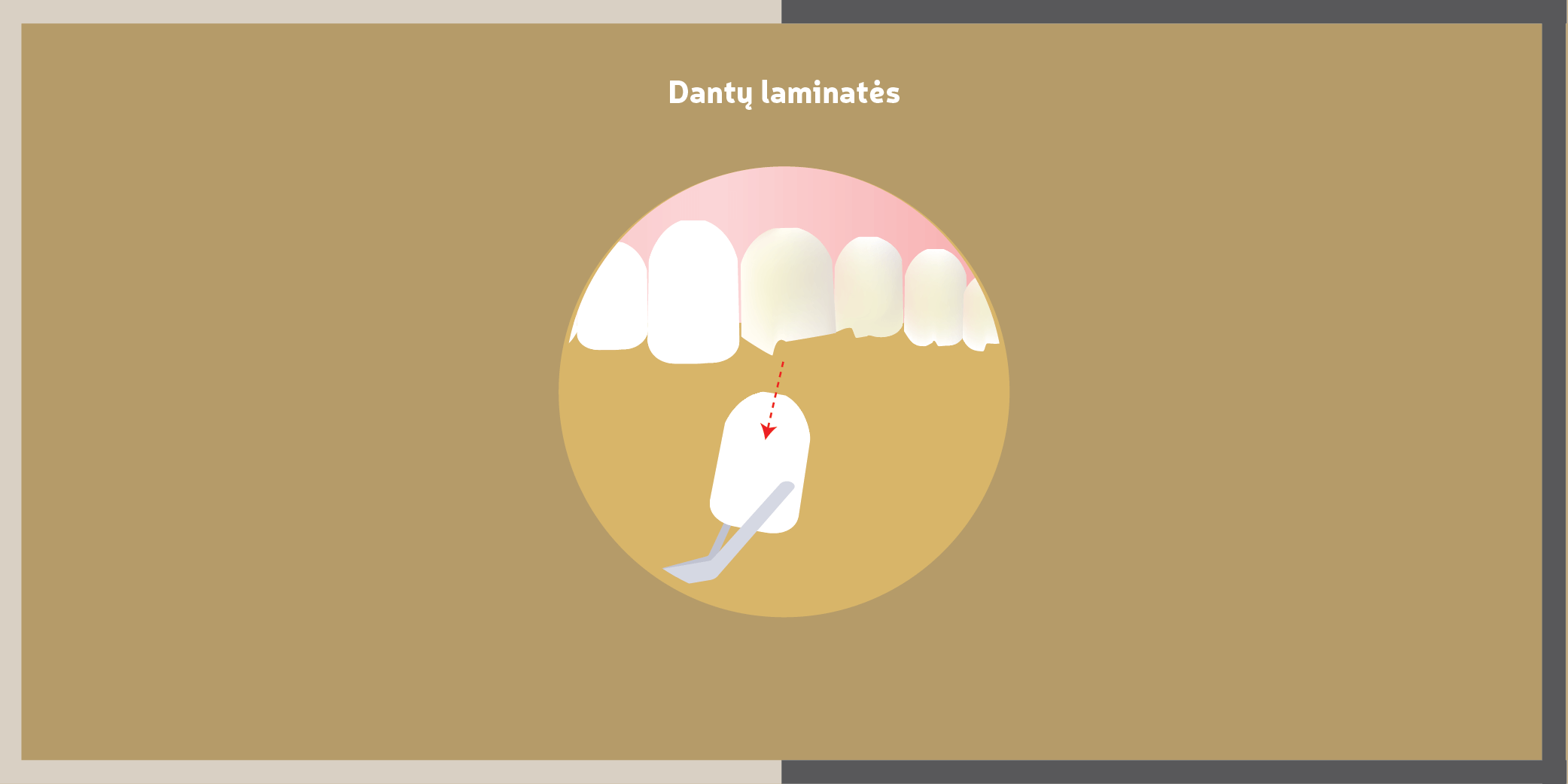 Dens Perfectus Dantų laminates