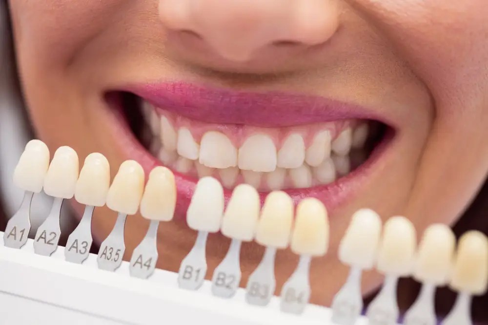 What are Veneers for Teeth DentaCenter