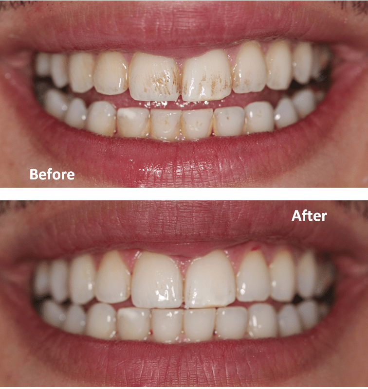 professionally cleaned teeth dentael