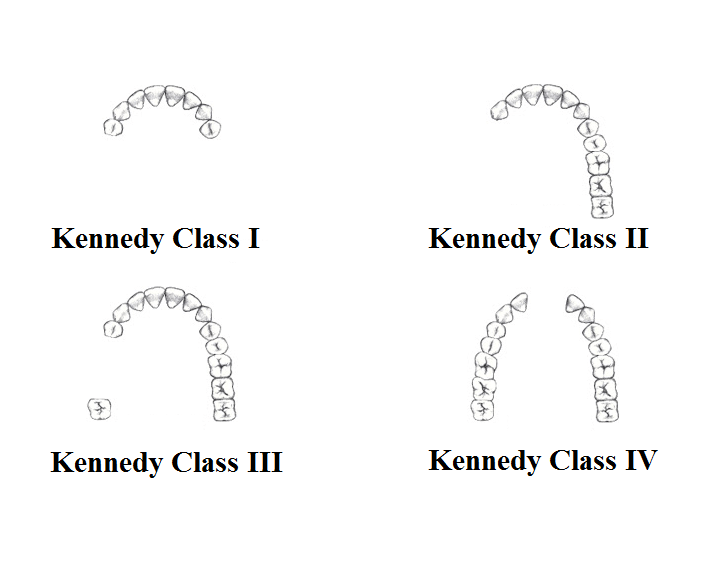 Kennedy Classification News Dentagama