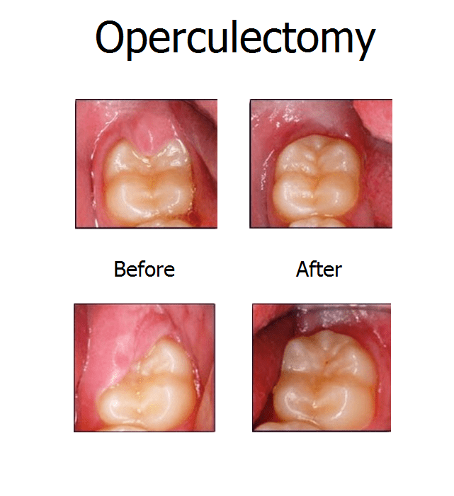 Operculectomy News Dentagama