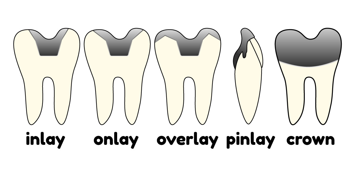 What is the difference between inlay, onlay, overlay and pinlay? News