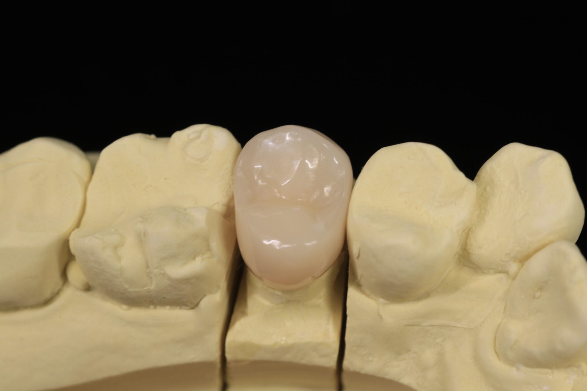 CAD/CAM冠（保険適用ハイブリッドレジン歯） Dental Blue Ocean 早川丸