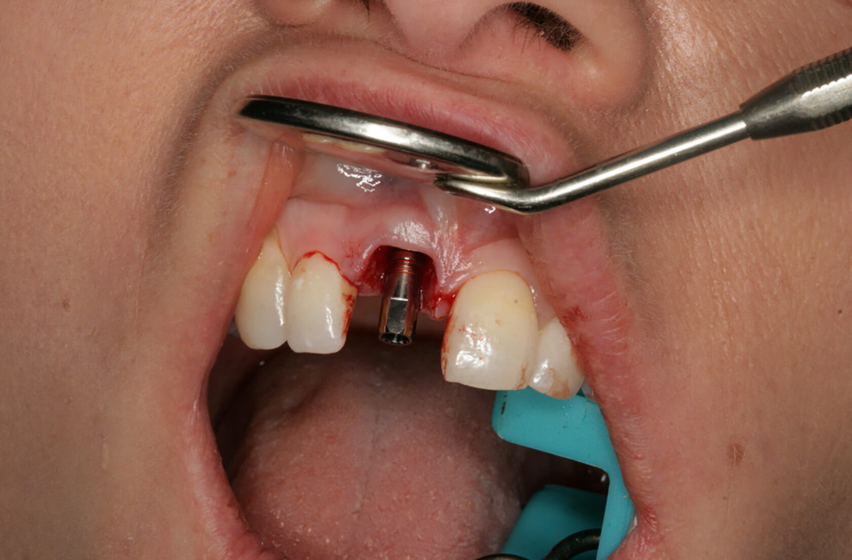 Single Stage Implant Extraction, Placement, Grafting, and Loading of