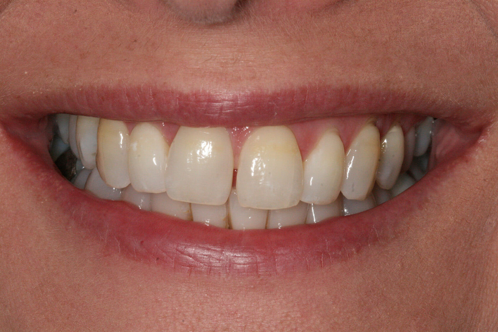 Single Stage Implant Extraction, Placement, Grafting, and Loading of