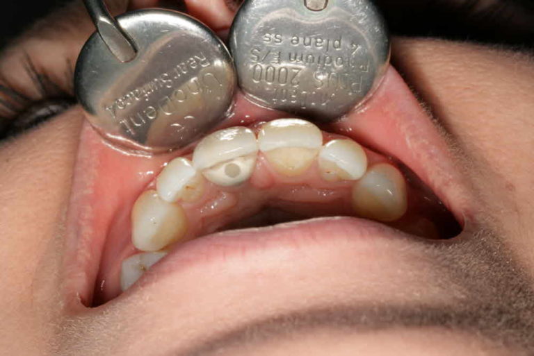 Part 2 Single Stage Implant Custom Impression Post and Final Crown