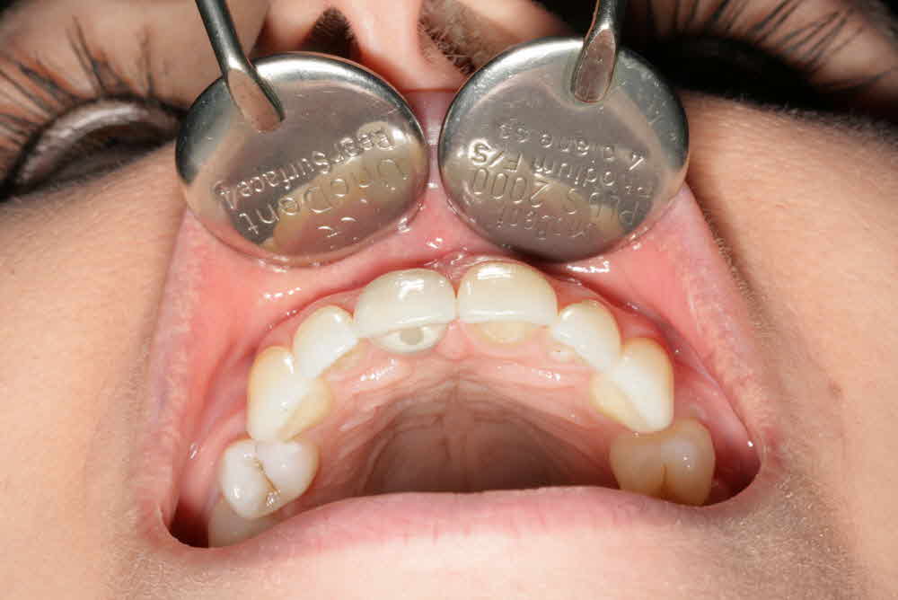 Part 2 Single Stage Implant Custom Impression Post and Final Crown