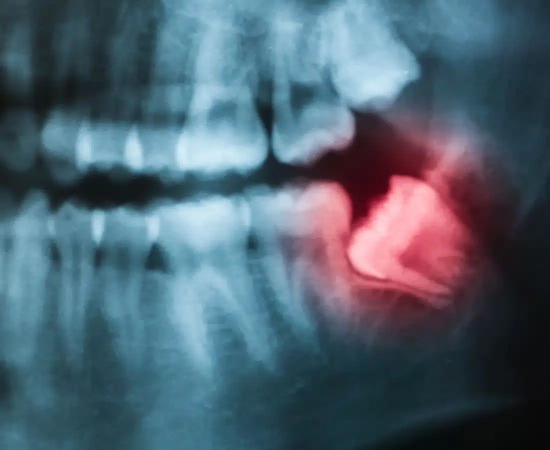 Wisdom Teeth Removals Clermont Dentistry