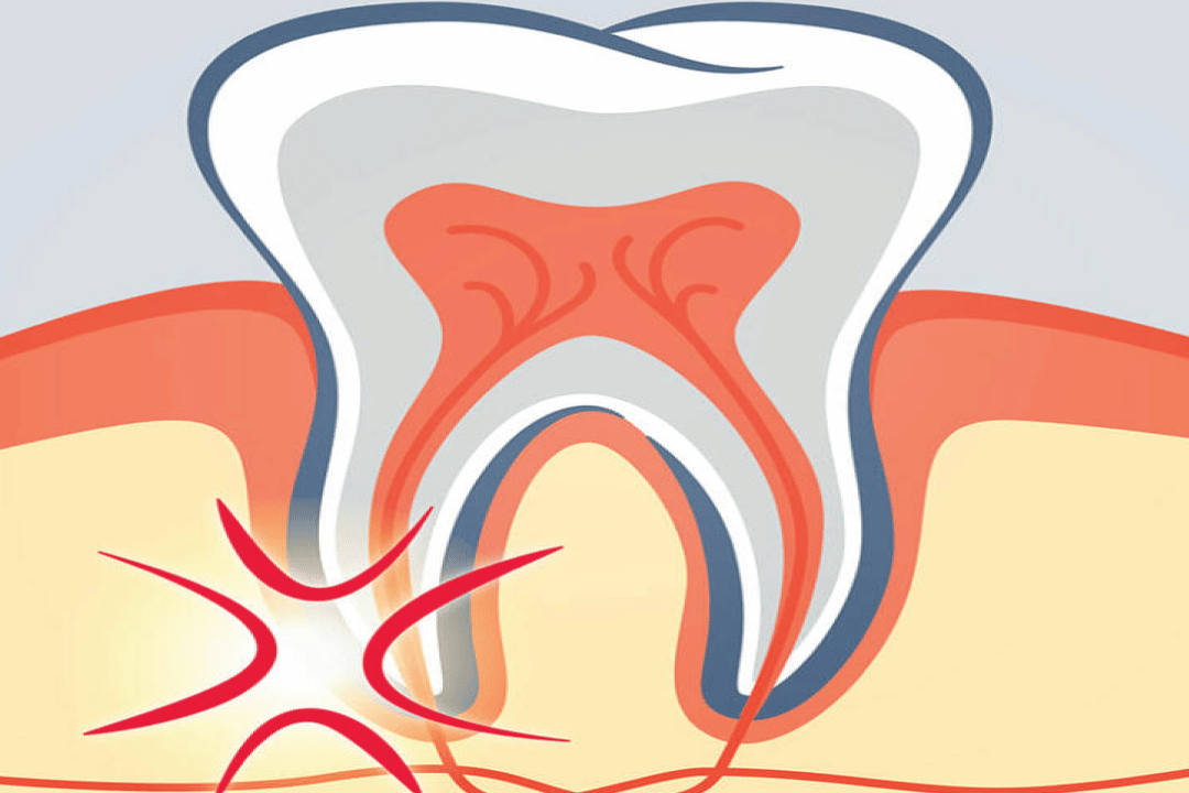 Root Canal Treatment FAQs Dental Depot