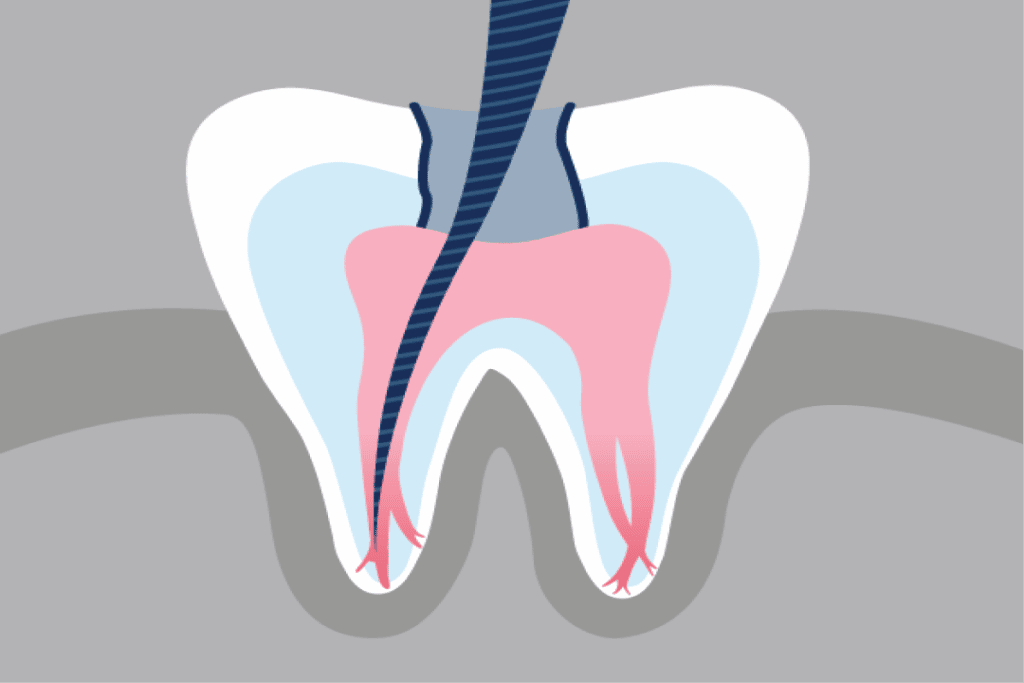 How Much is a Root Canal With and Without Insurance Dental Depot DFW