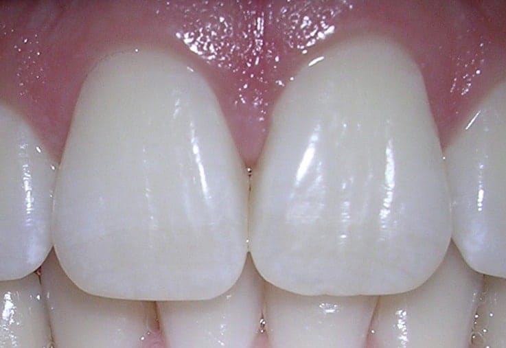 Decreasing Sensitivity When Teeth Whitening