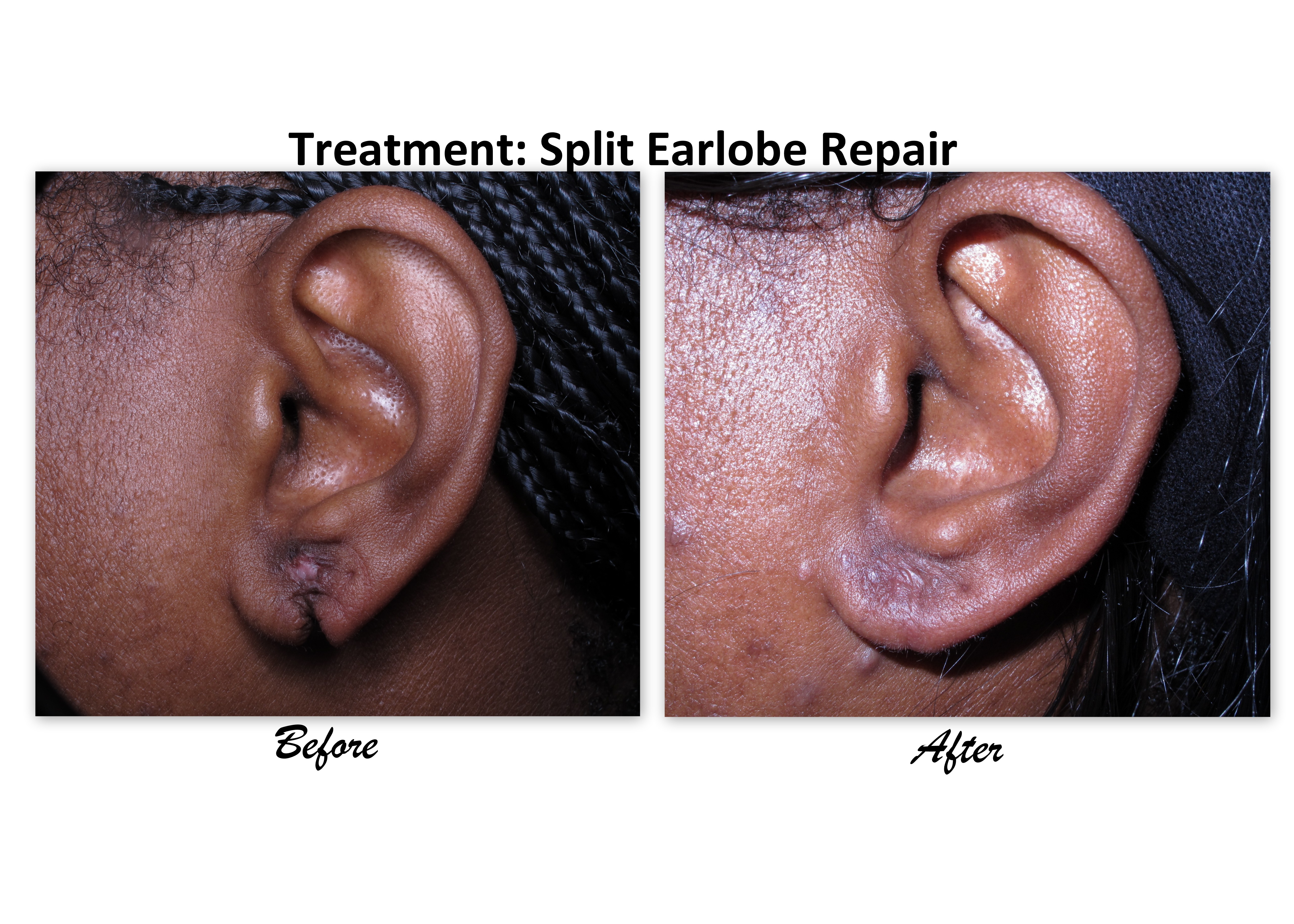 Earlobe Repair Dentist South Side Chicago IL